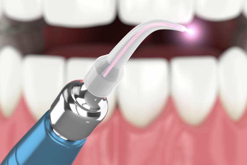 Minimal Invasive Dentistry in  Huntington Beach