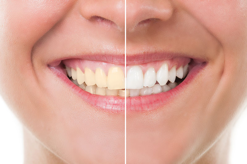 Teeth Whitening in  Huntington Beach